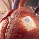 Insuffisance cardiaque: ce patch aux cellules souches pourrait remplacer les transplantations d