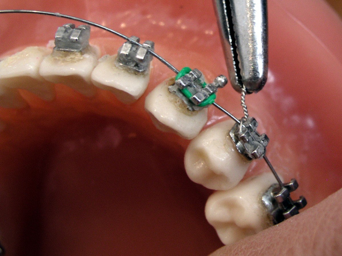 La gouttière dentaire au cœur de l'orthodontie fonctionnelle