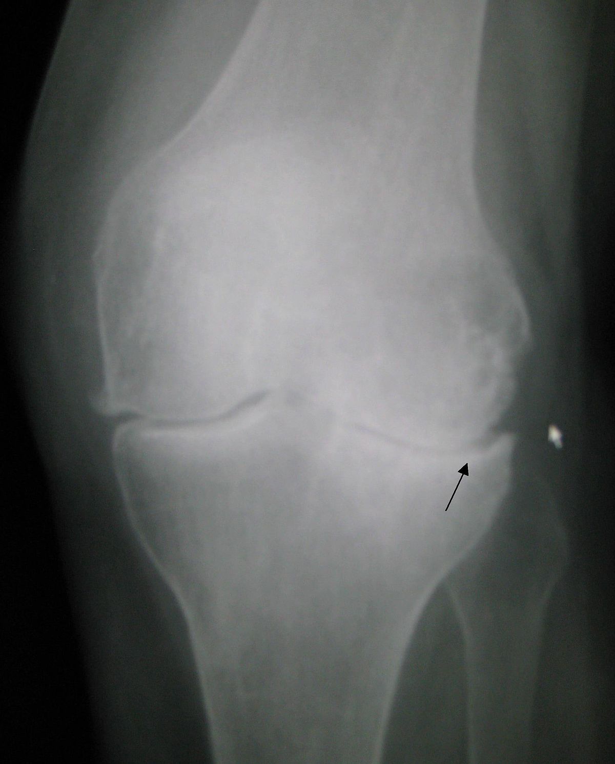 Osteoarthritis left knee.jpg