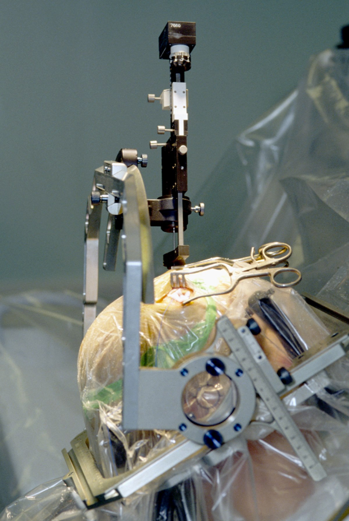 Opération neurochirurgicale