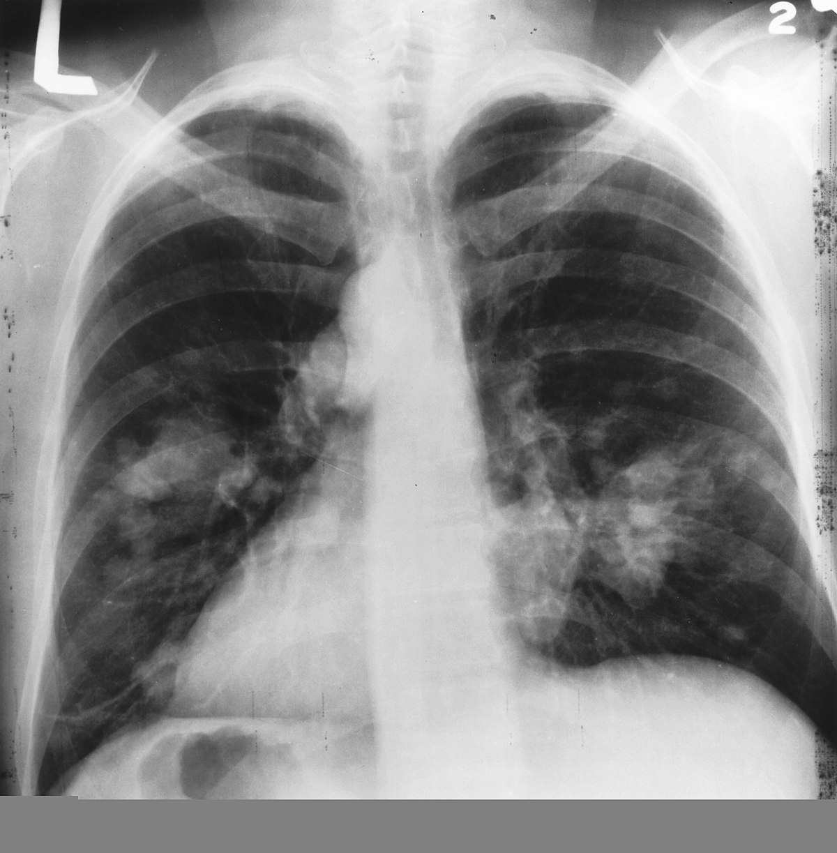 🔎 Cancer du poumon - Définition et Explications