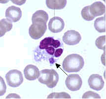  Morula dans le cytoplasme d'un neutrophile (point bleu marqué par la flèche)