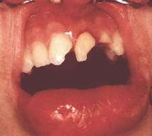 Fracture dent.jpg