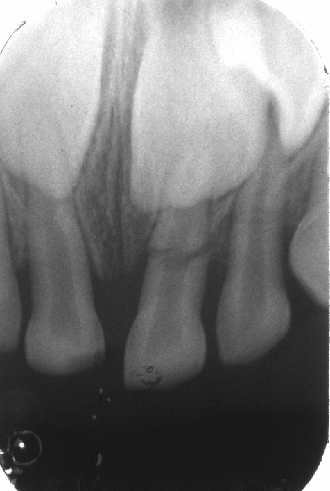 Fracture radiculaire.jpg