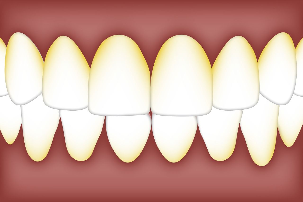 Quel est le lien entre plaque dentaire et caries ? 