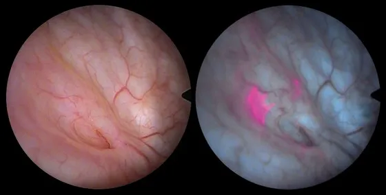 Des lumières qui révèlent le cancer