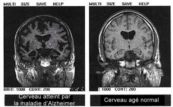 Gagner deux ans sur le diagnostic de la maladie d'Alzheimer
