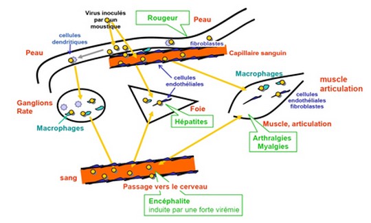 Chikungunya : du nouveau sur la maladie