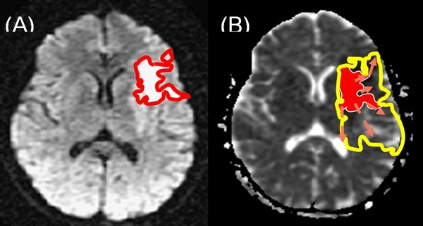 NEURiNFARCT: prévoir l'évolution des accidents vasculaires cérébraux