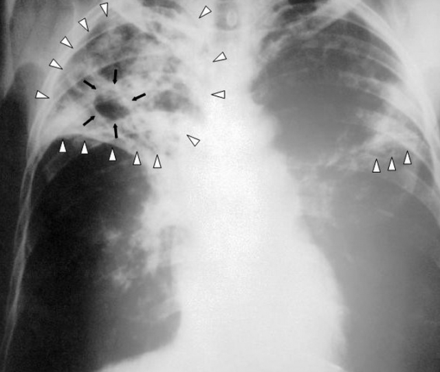 Nouvelles données sur la tuberculose dans le monde