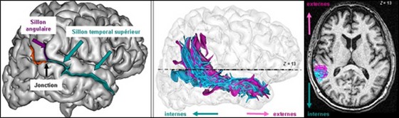« D’où viennent les voix ? » : anatomie du cerveau de patients schizophrènes
