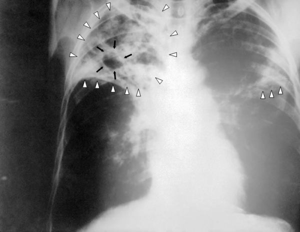 Découverte d’un nouveau candidat vaccin contre la tuberculose
