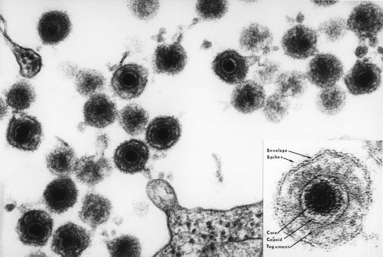 Un virus pourrait déclencher la sclérose en plaques