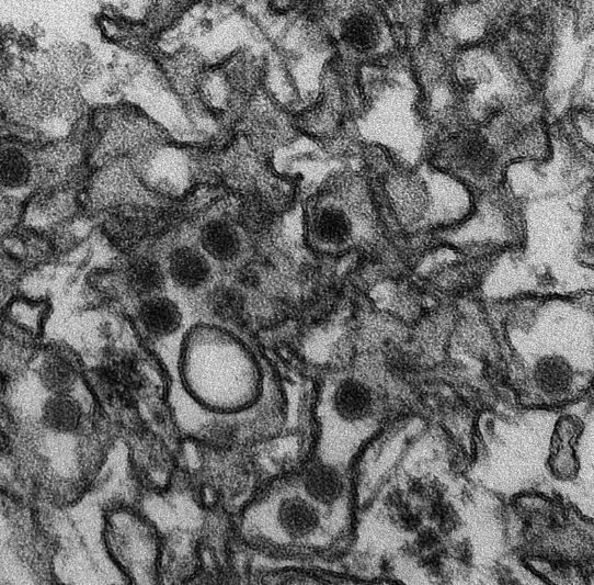 Définition du syndrome associé à l’infection congénitale à virus Zika