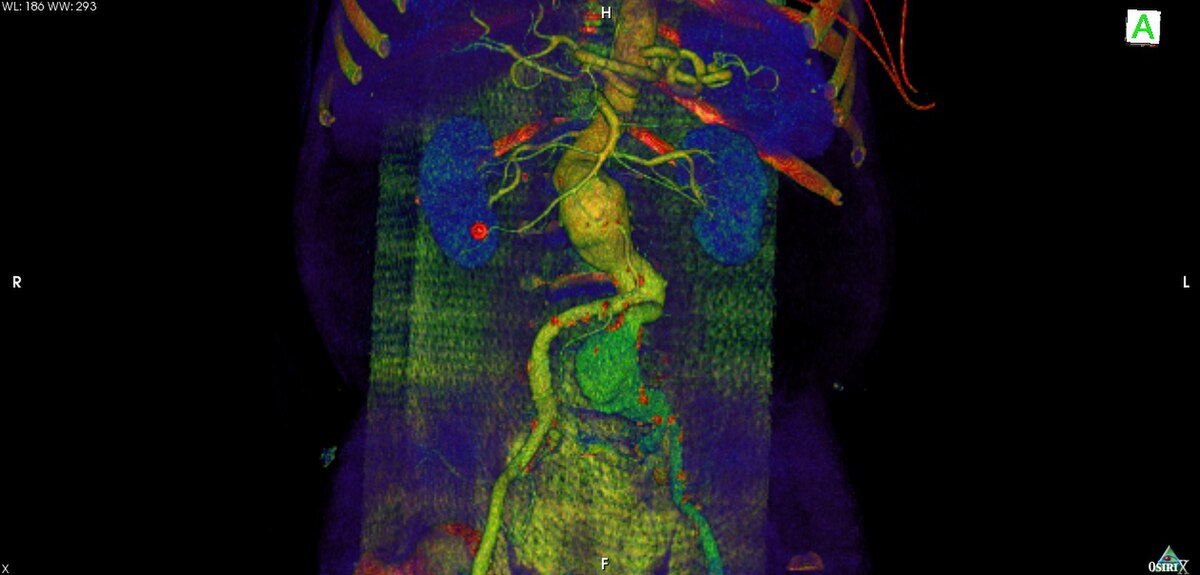 Endoprothèse aortique