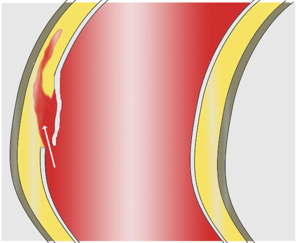 Dissection aortique