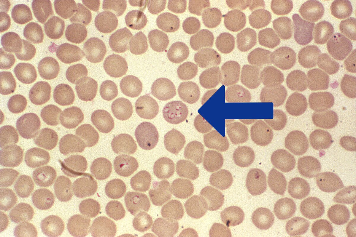 Babésiose