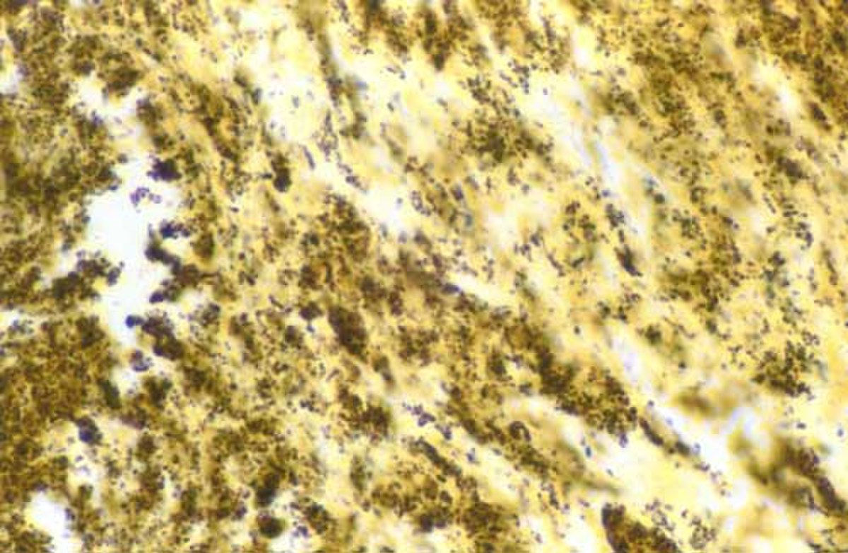 Endocardite à Bartonella henselae. (Les bactéries sont les petits grains noirs)