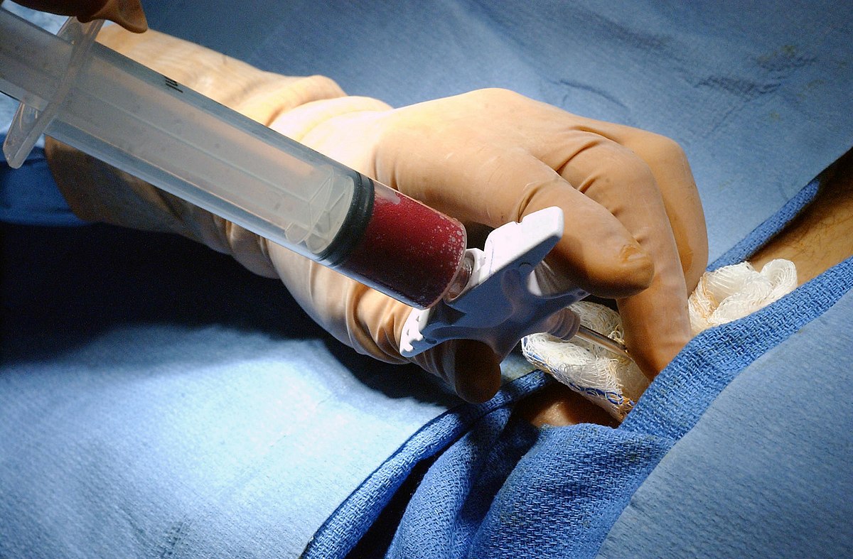 Transplantation de moelle