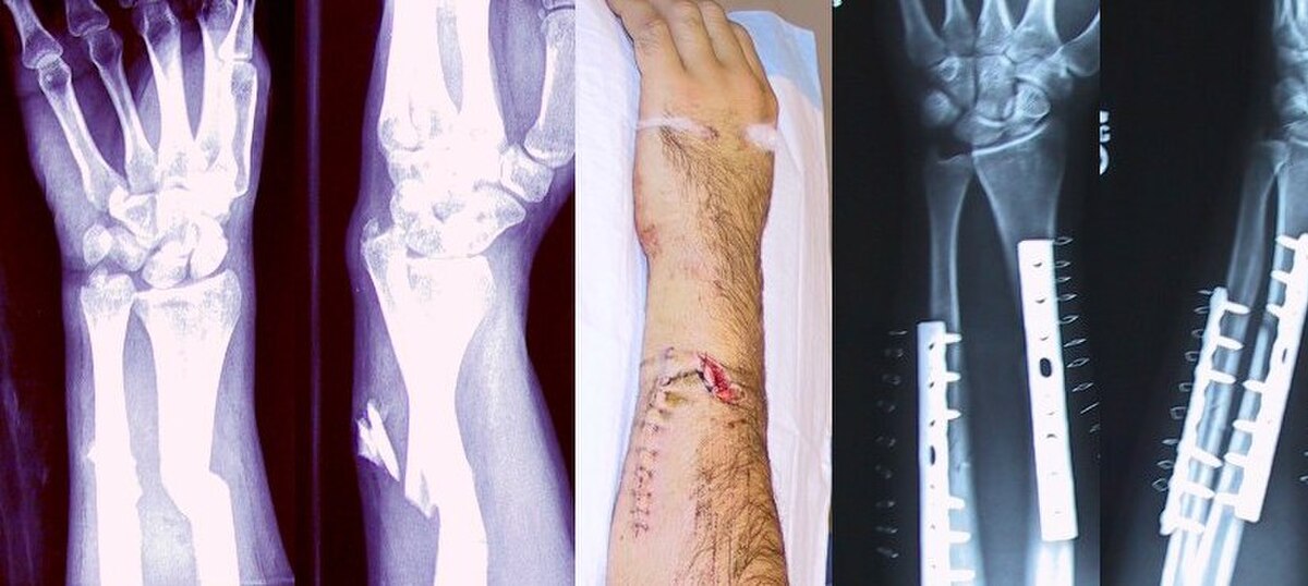Fracture