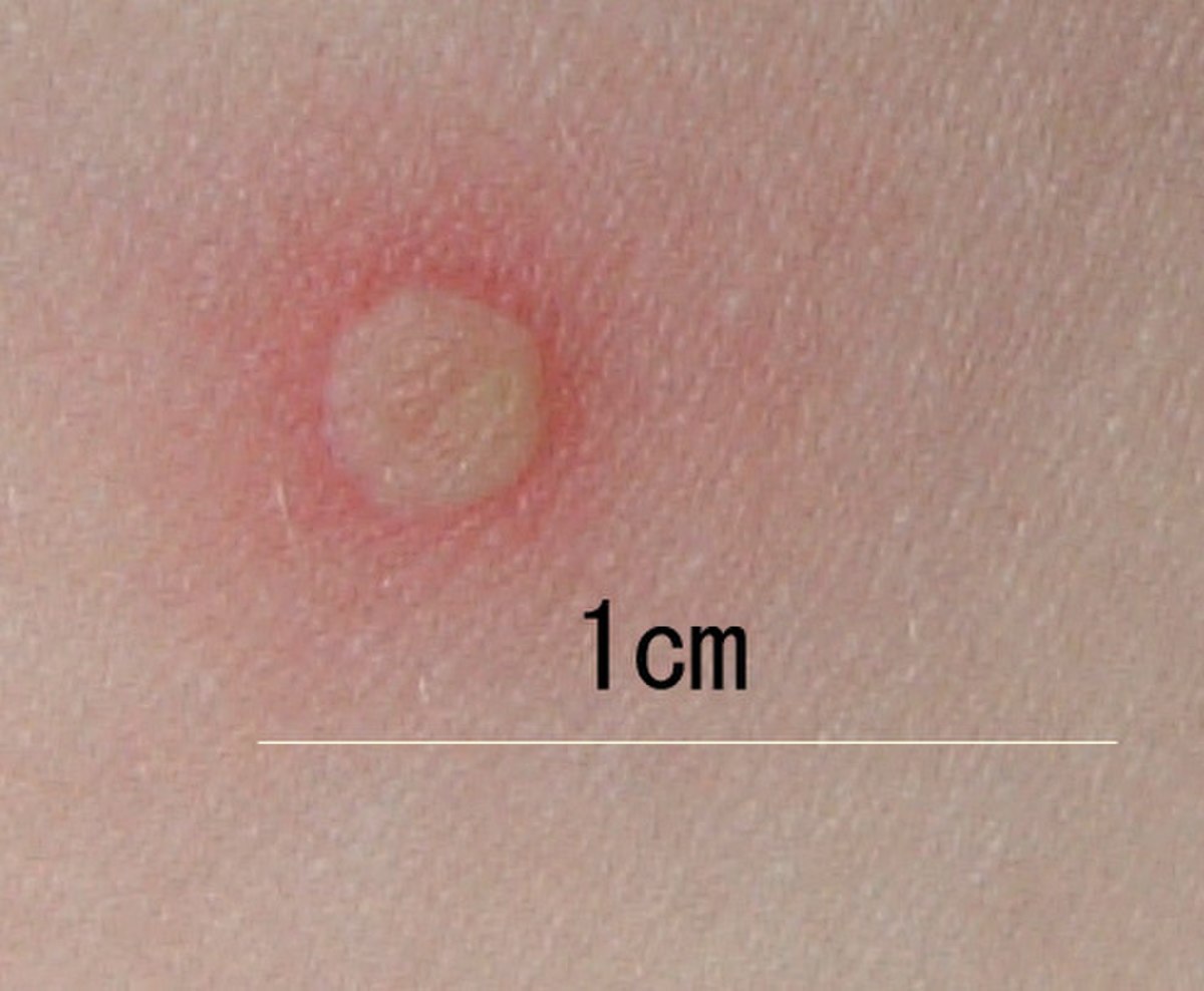 Chickenpox blister-(closeup).jpg