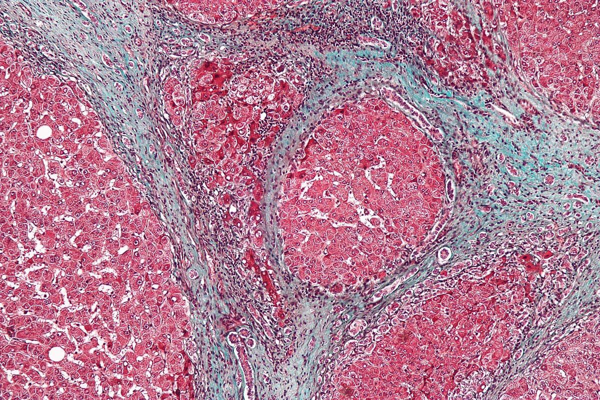 Cirrhose