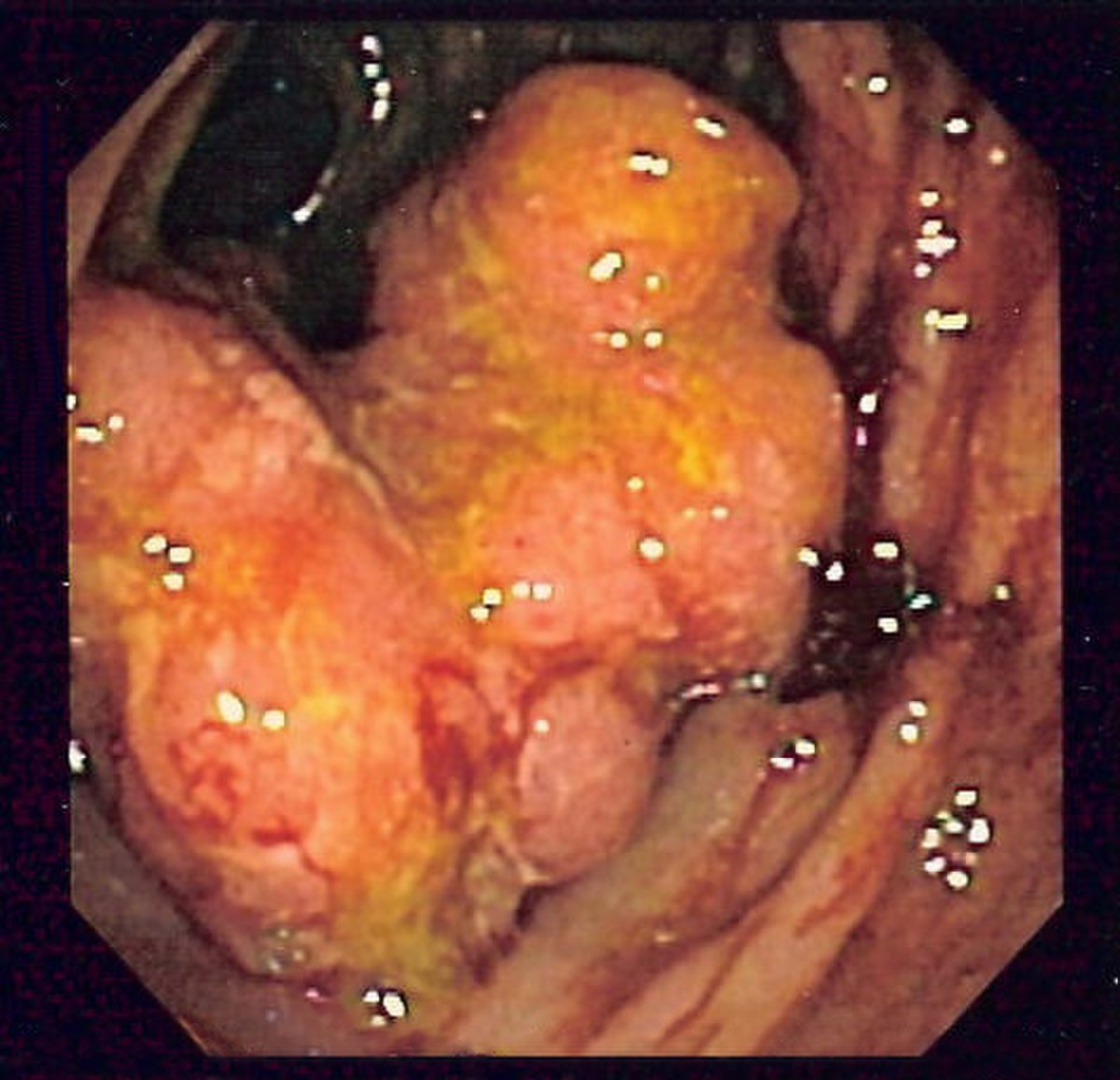 Cancer du rectum
