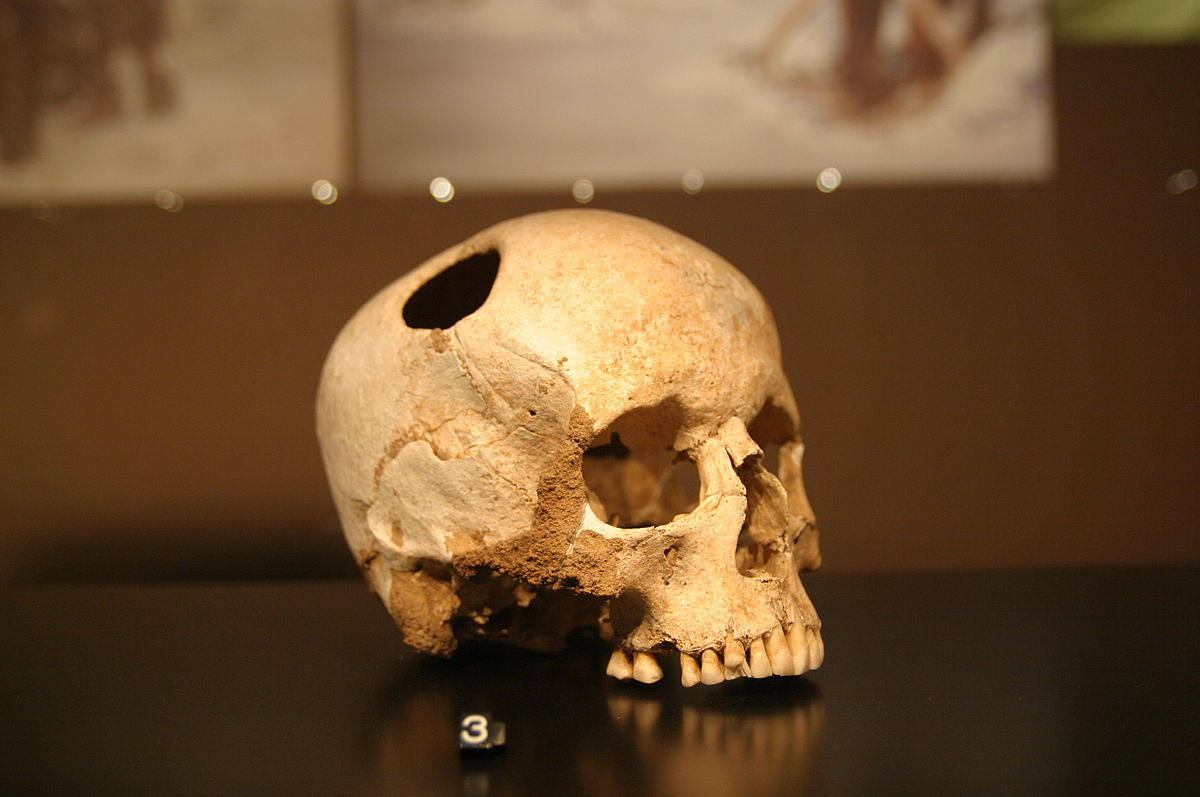 Médecine dans la Préhistoire et la Protohistoire