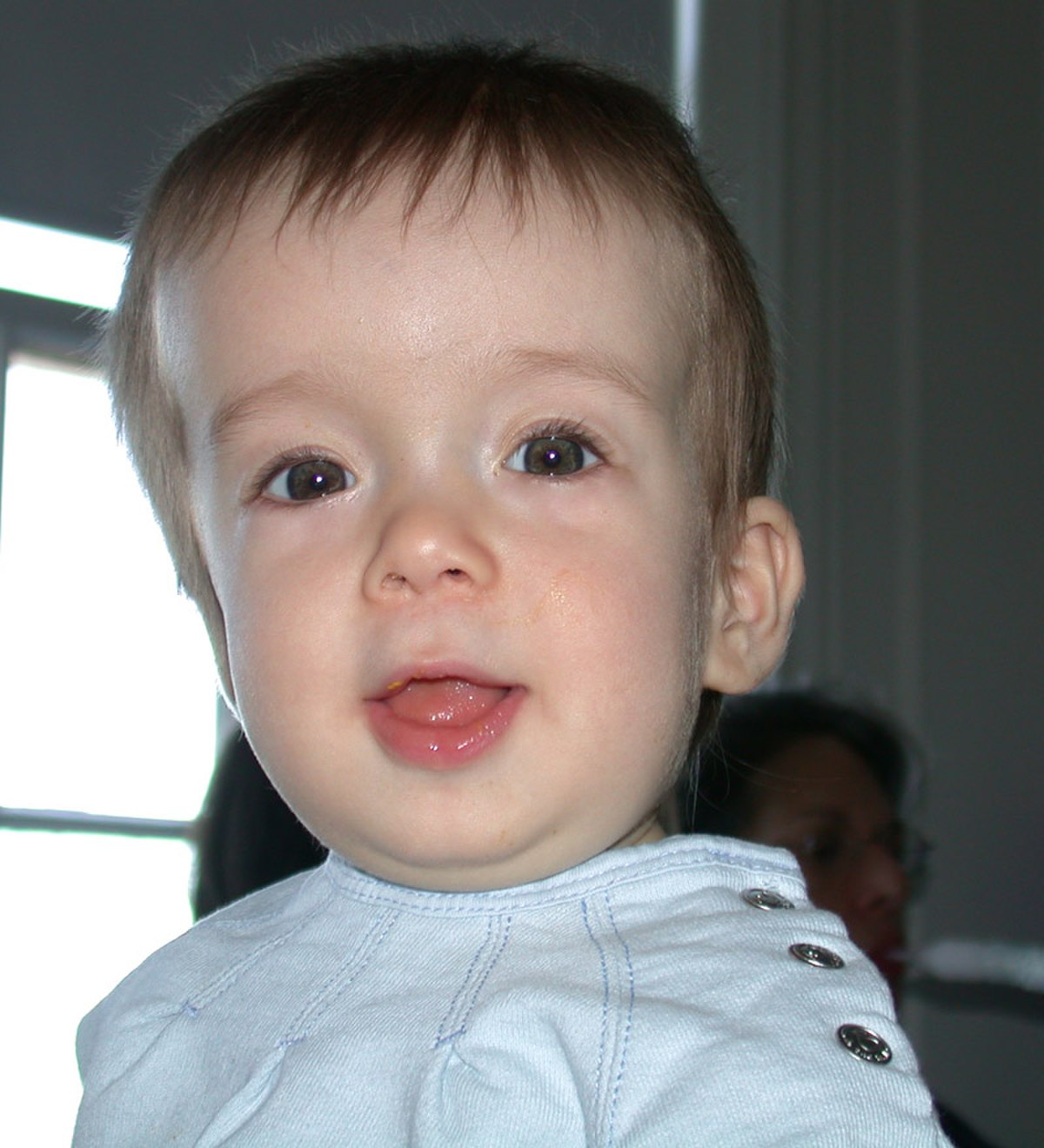 Craniosynostose