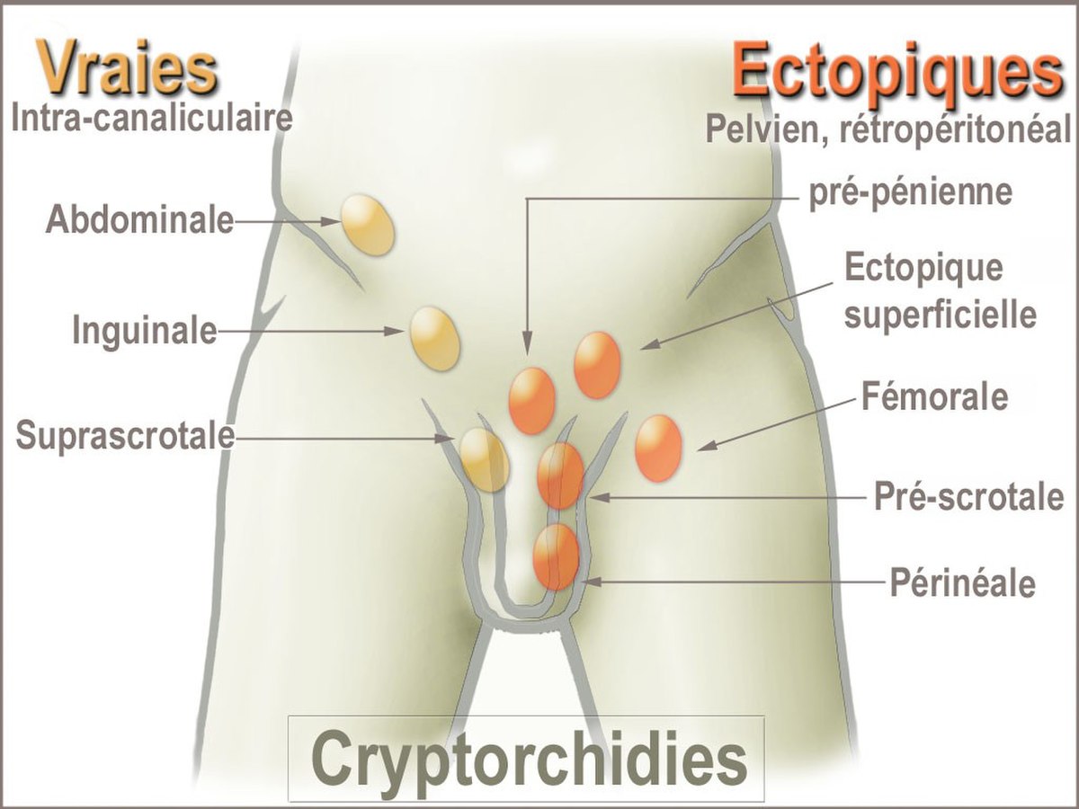 Ectopie testiculaire
