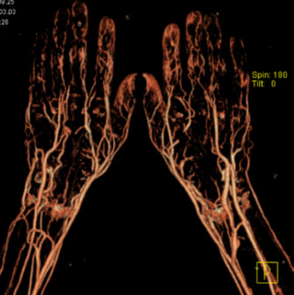 Angiographie