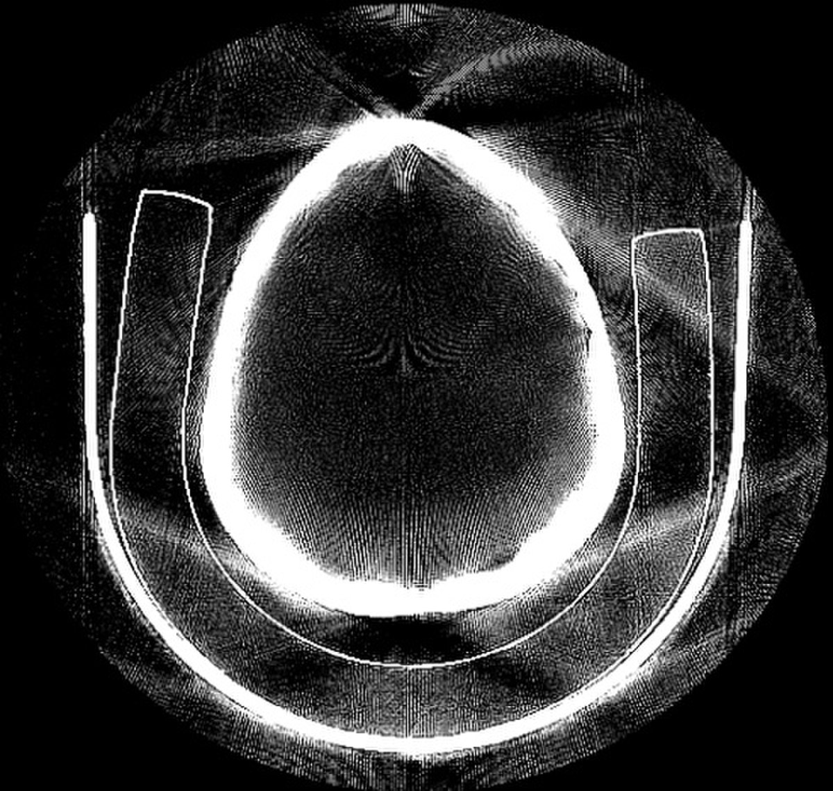 Les projections des rayons-X sont clairement visibles dans cette coupe prise par un scanner