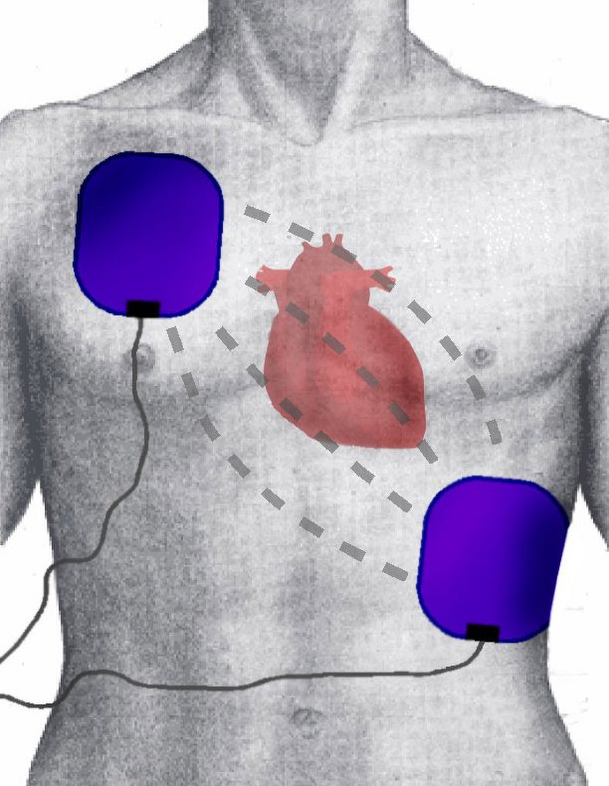 Défibrillation