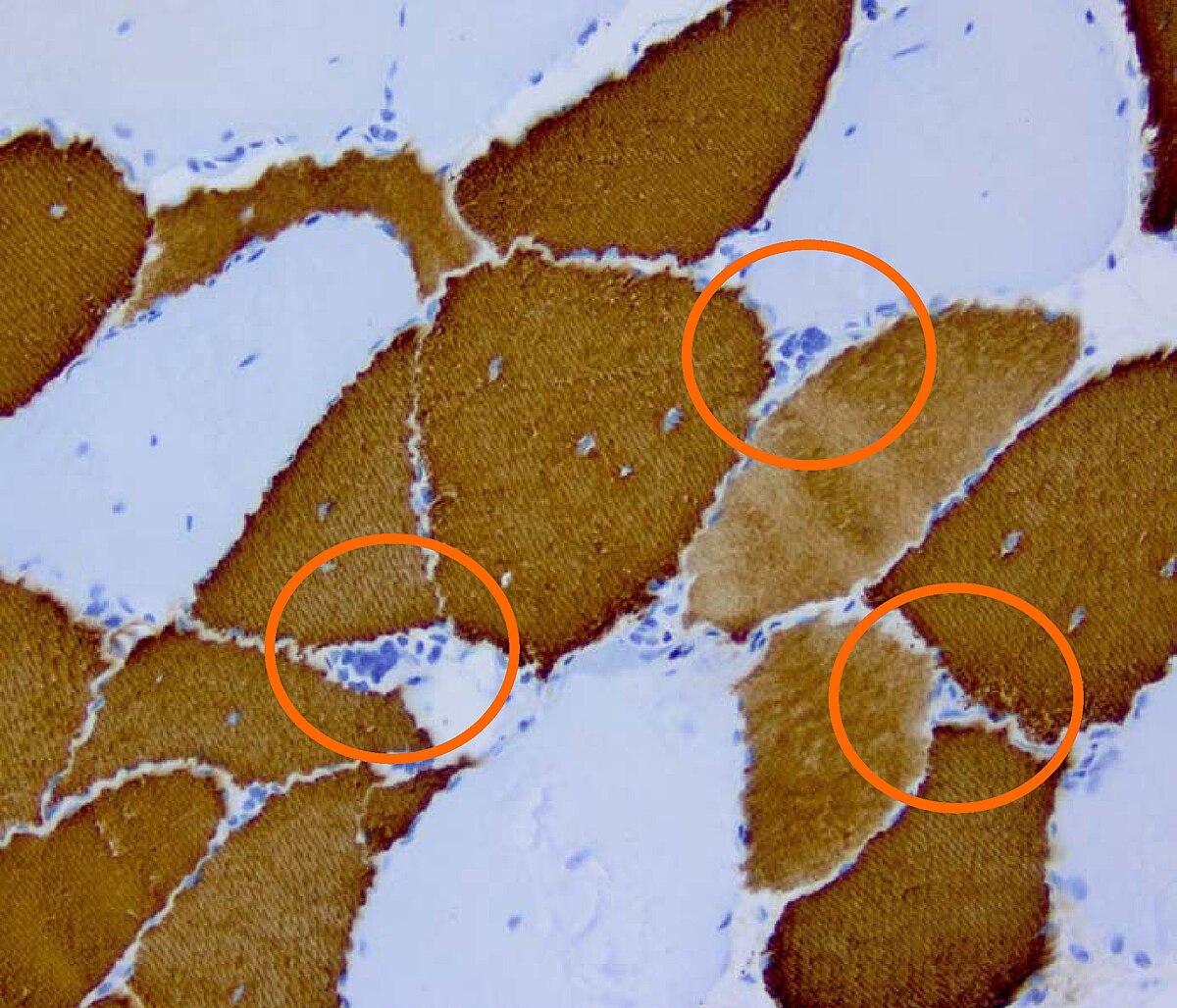Dystrophie myotonique de Steinert