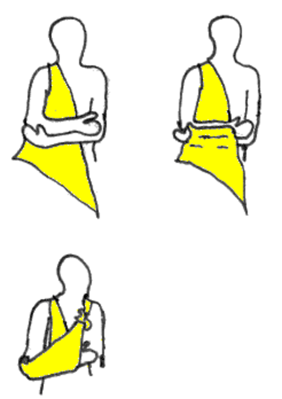 Écharpe (médecine)
