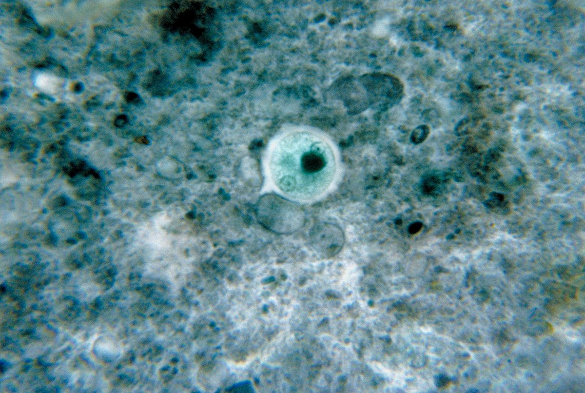 Amoebose