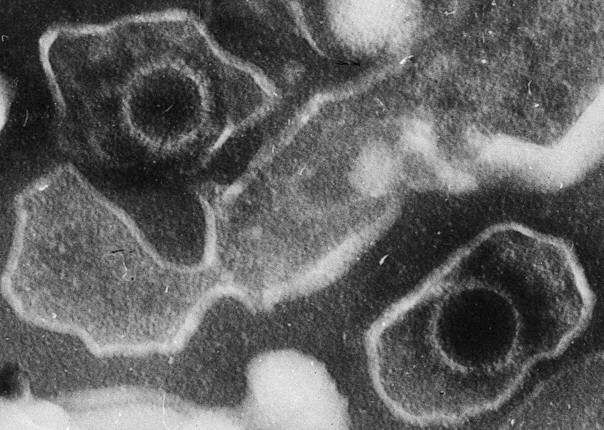 Virus d'Epstein-Barr