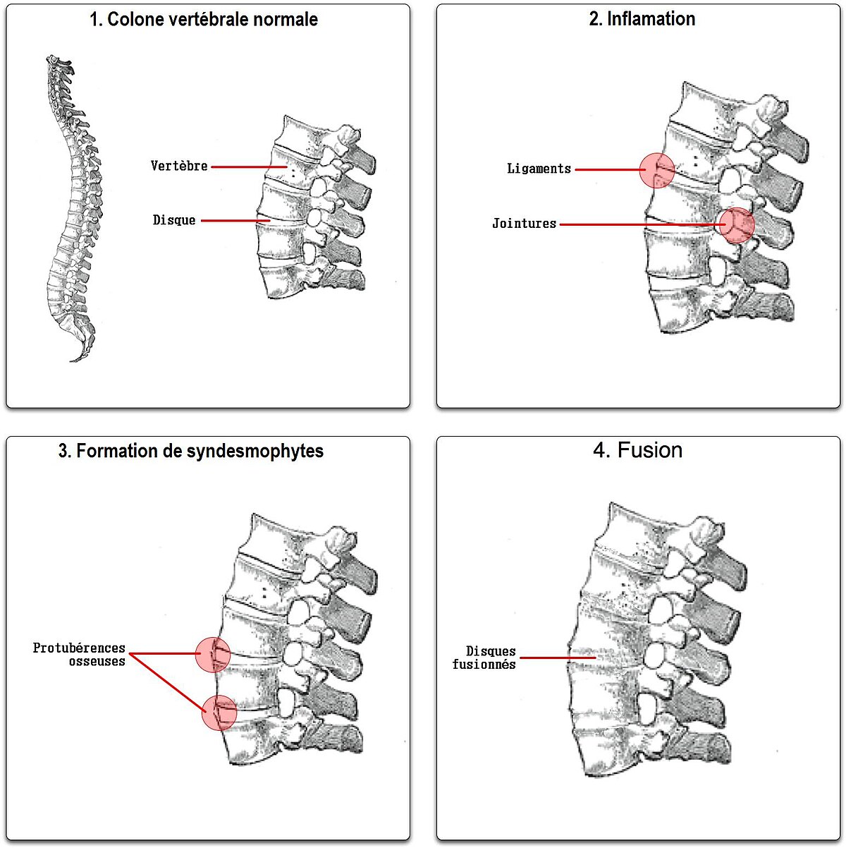 Spondylarthrite ankylosante