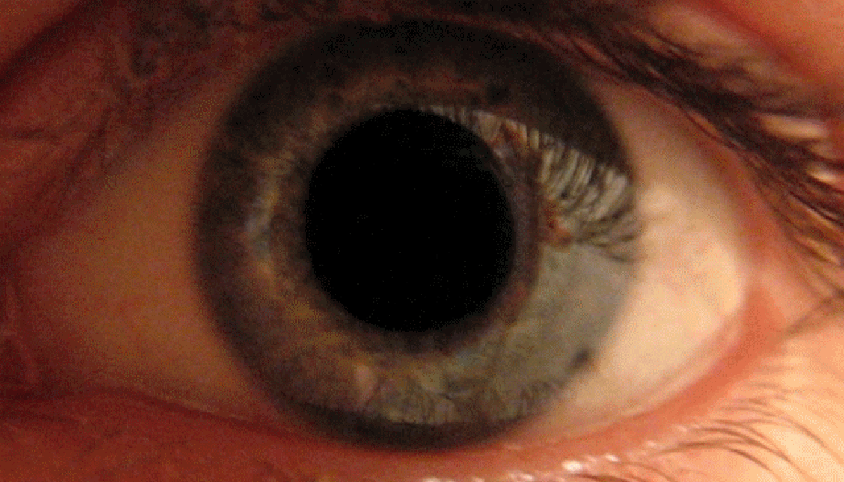 Iris (anatomie)