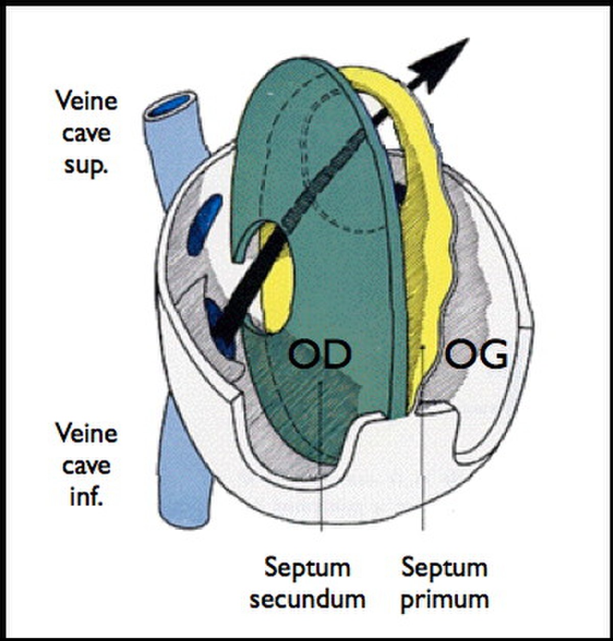 Foramen ovale perméable