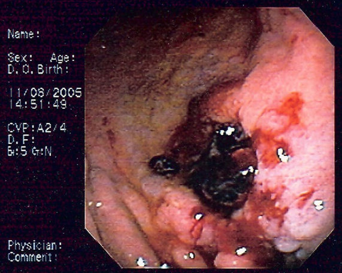 Lymphome