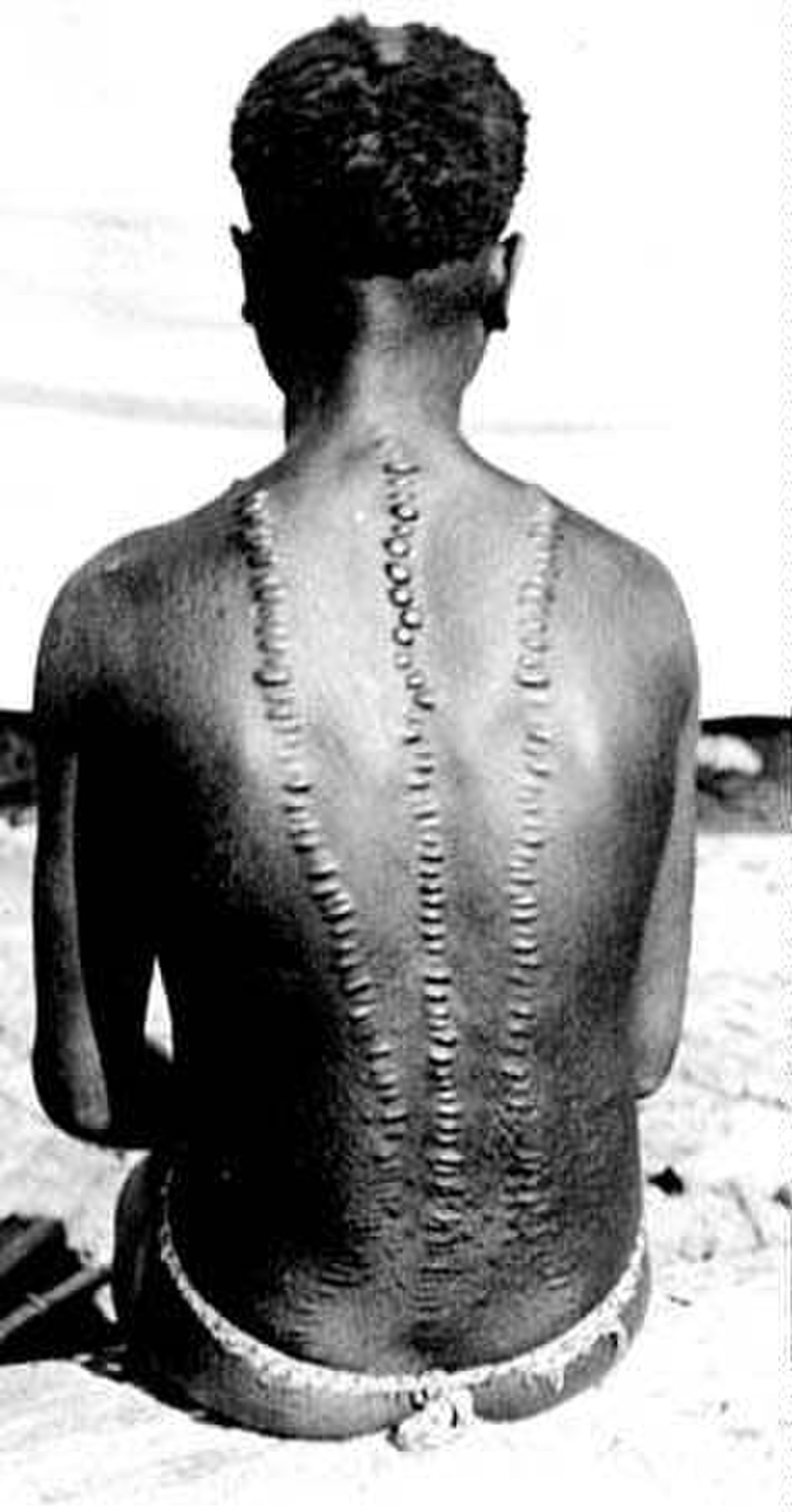 Scarification (incision)
