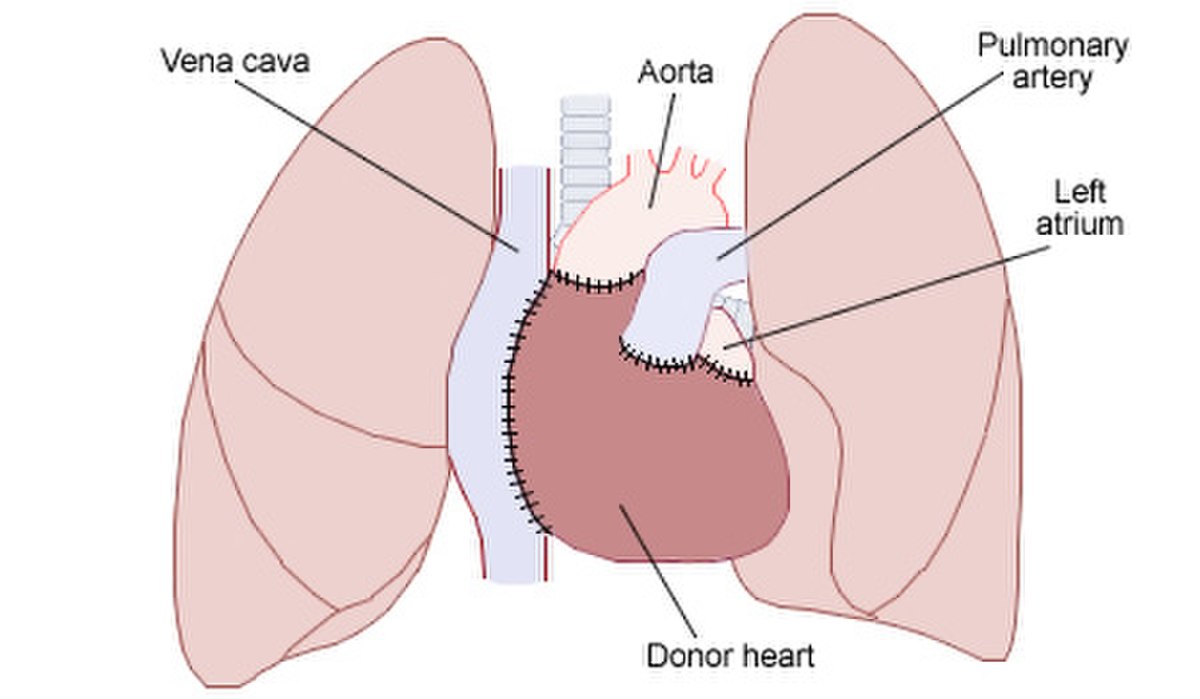 Transplantation cardiaque