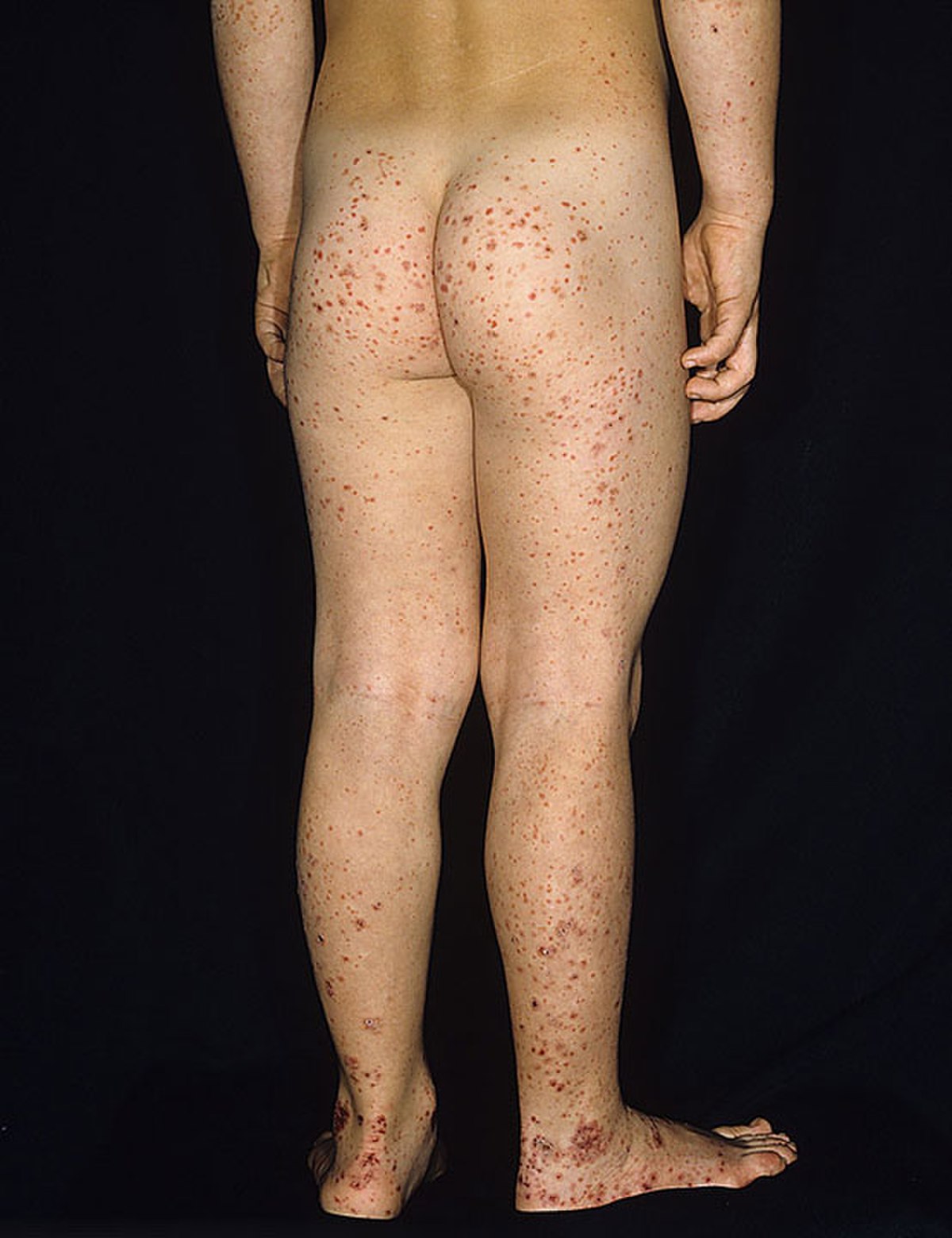 Purpura rhumatoïde