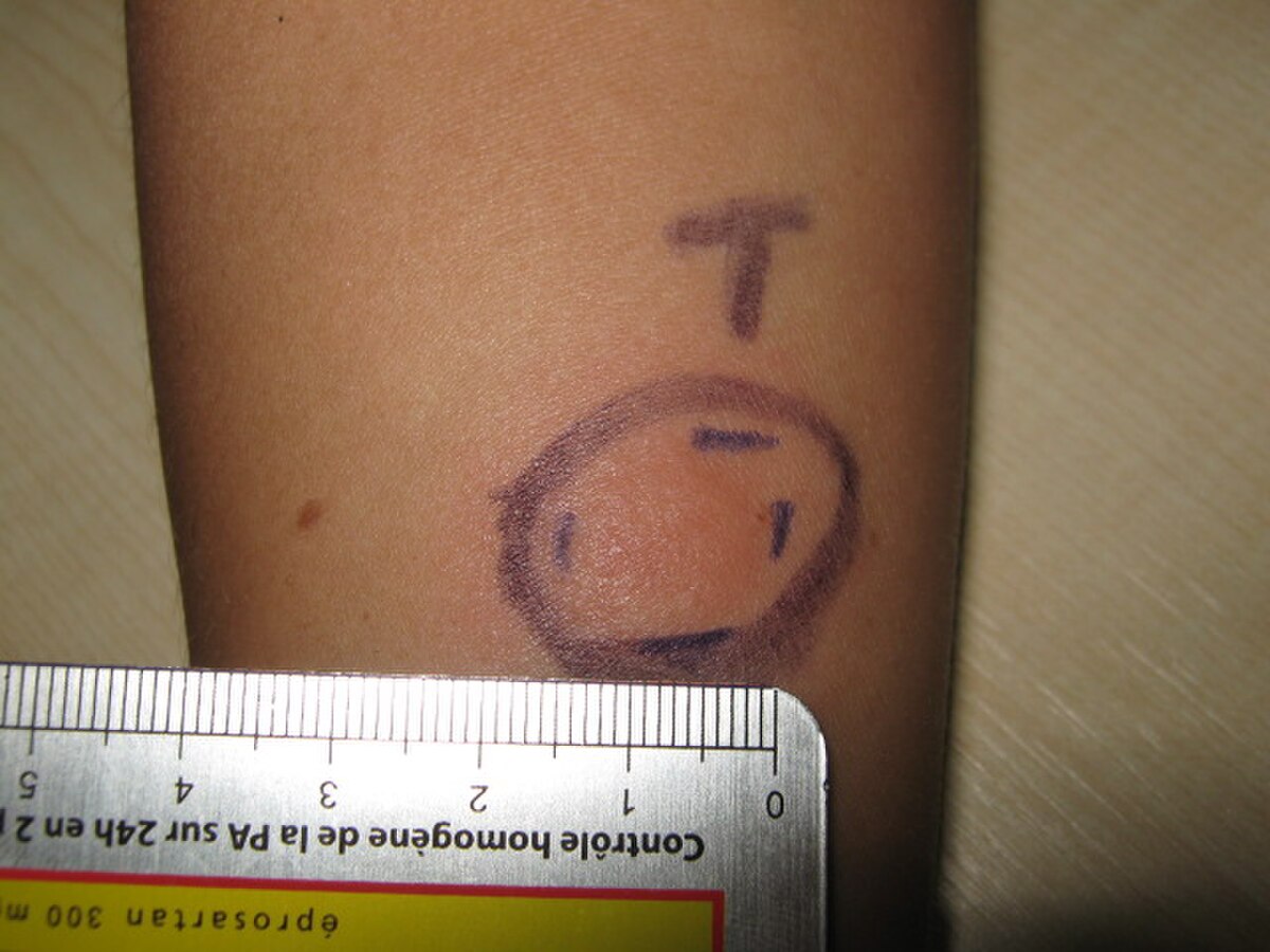 Test Mantoux