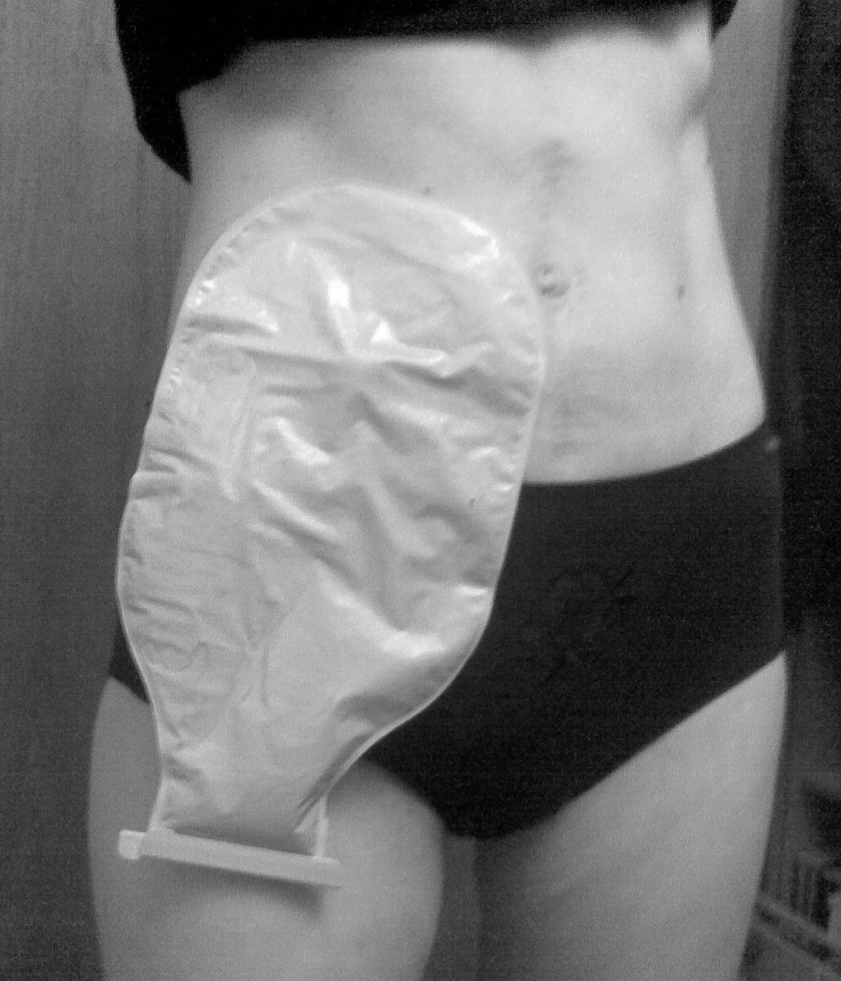 Ileostomy with bag.jpg