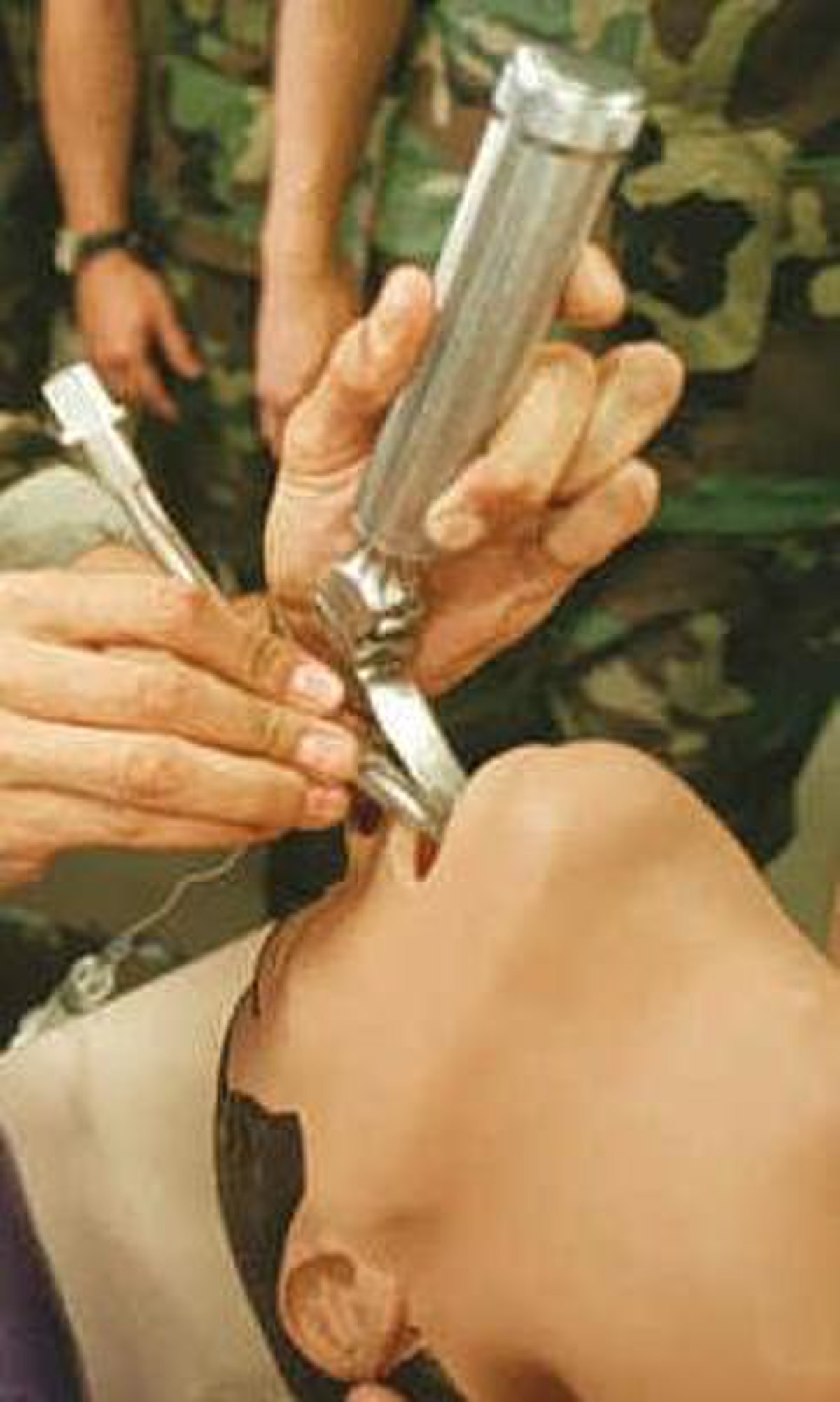 Intubation trachéale