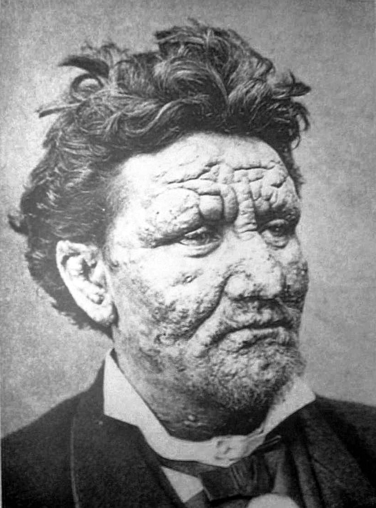 Lèpre