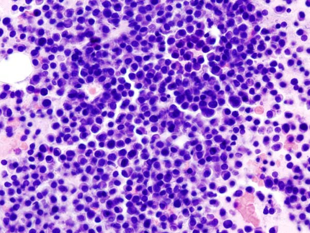 Myélome multiple