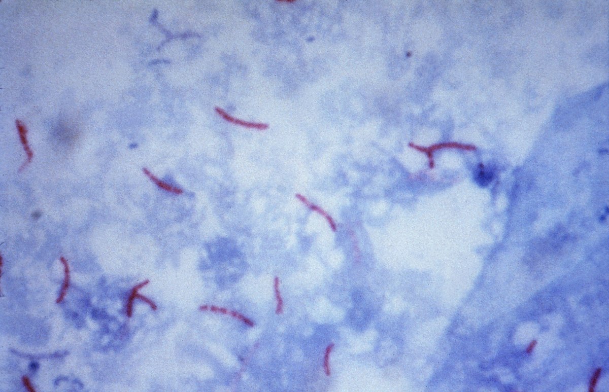 Mycobacterium tuberculosis par la coloration de Ziehl-Neelsen